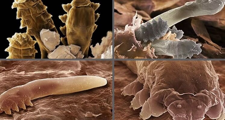 rodzaje ludzkich pasożytów skórnych